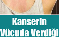 Kanserin Vücuda Verdiği 10 Belirti