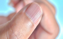 Tırnaklarınızdaki Dikey Çizgiler Size Ne Anlatıyor
