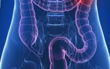 Kalın Bağırsak Kanseri