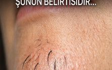 Beslenmenin Kadınlarda Çene Kıllarının Büyümesi