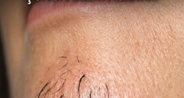 Beslenmenin Kadınlarda Çene Kıllarının Büyümesi