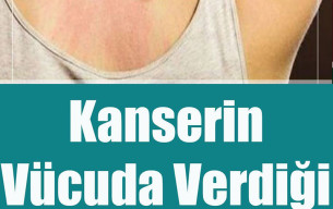 Kanserin Vücuda Verdiği 10 Belirti